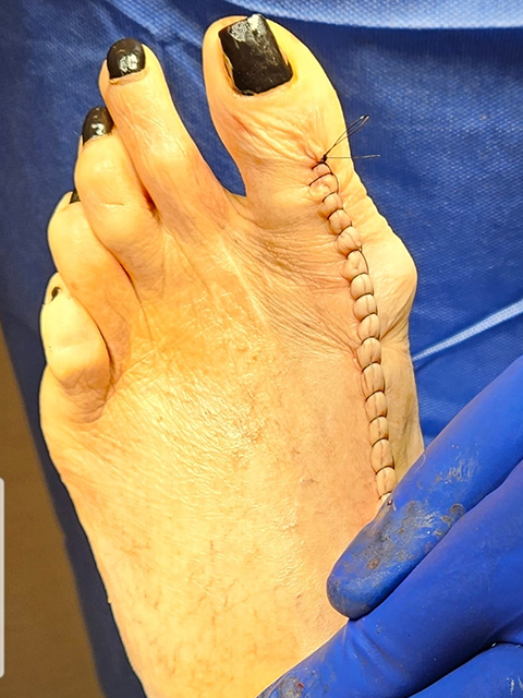 Bunion After Surgery