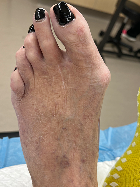 Bunion Before Surgery
